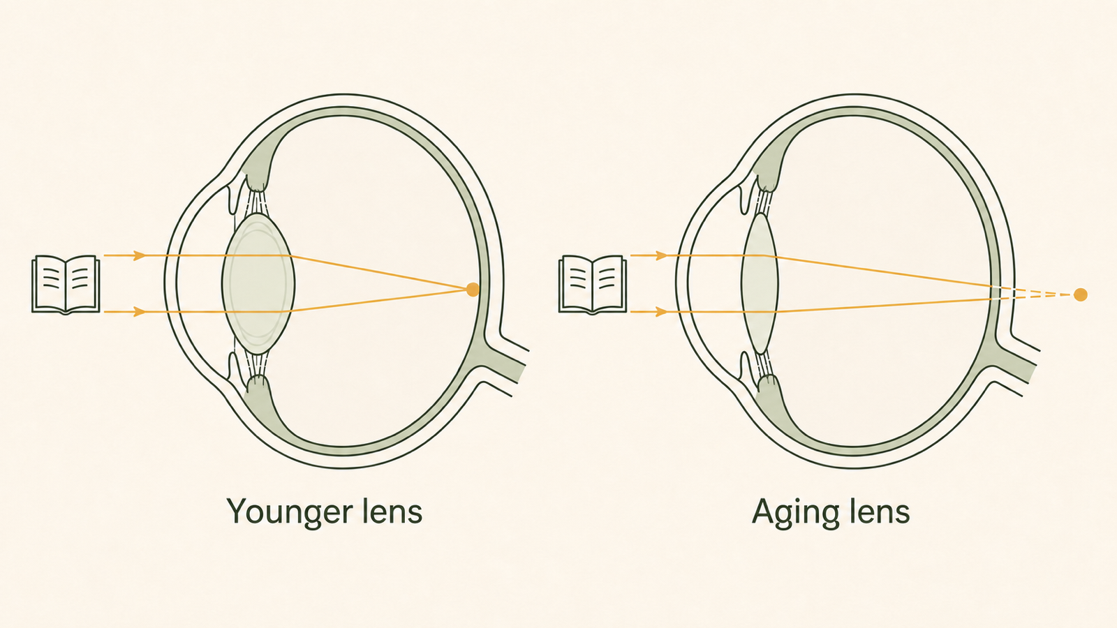 A younger flexible lens focuses near light on the retina, while an aging stiffer lens would focus behind the retina.